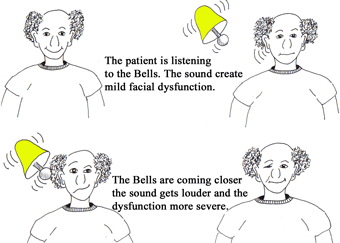 Bell's-palsy---ready.gif
