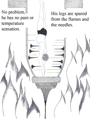 syringomyelia-3.gif